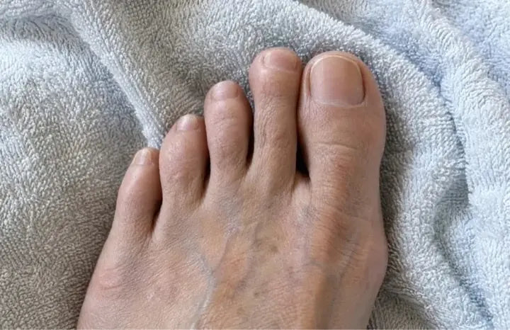 Christine's foot thirteen months after she started