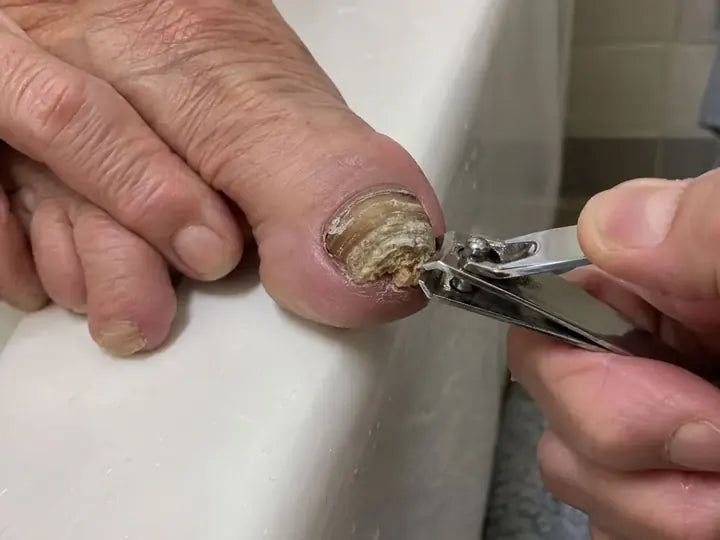 A very thick yellow toenail that a small clipper can't cut