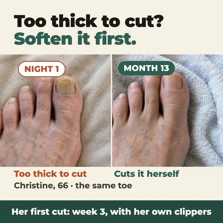 Christine's big toe on night 1 and at month 13: too thick to cut, then she cuts it herself