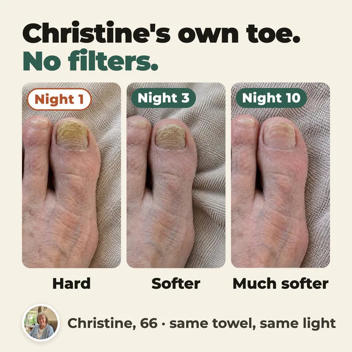 Christine's own toe on night 1, night 3 and night 10, same towel