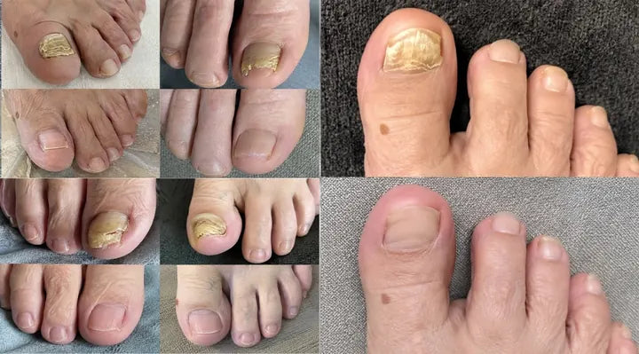 Five trial participants' big toenails on day 1 and at week 12